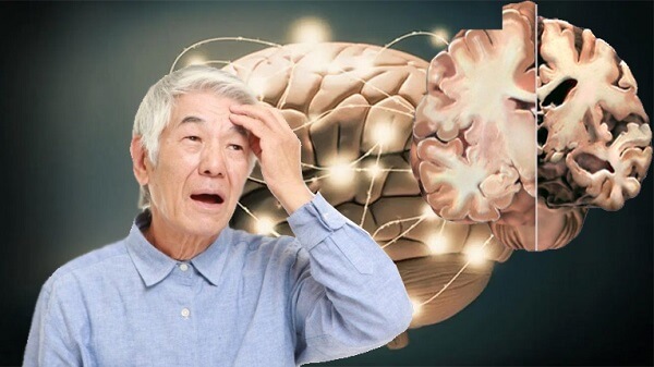 Bệnh Alzheimer là bệnh lý về não, khiến người bệnh bị lẫn, mất trí nhớ